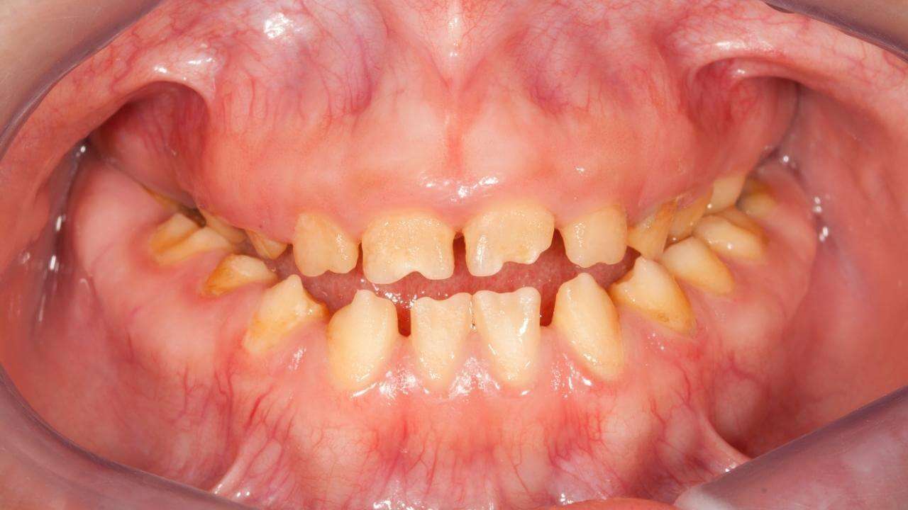 amelogenesi imperfetta cura