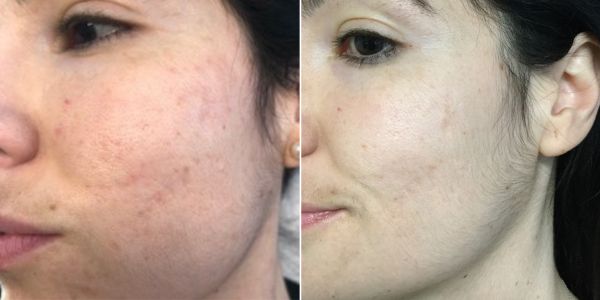 rimozione cicatrici acne unisalus