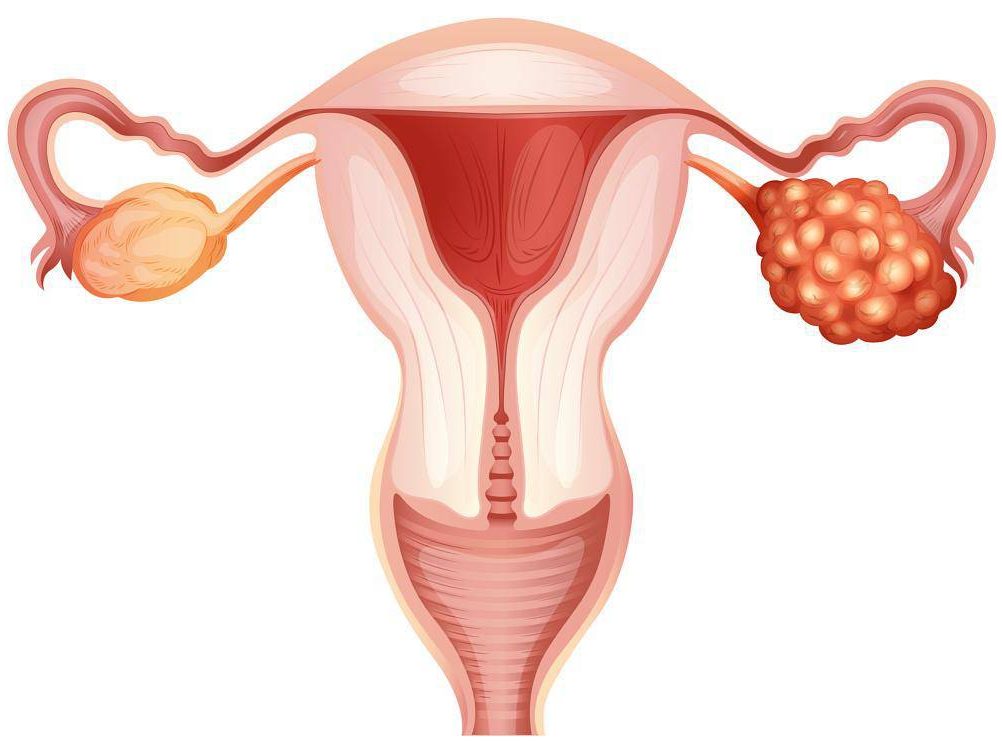 Cisti-ovariche-milano