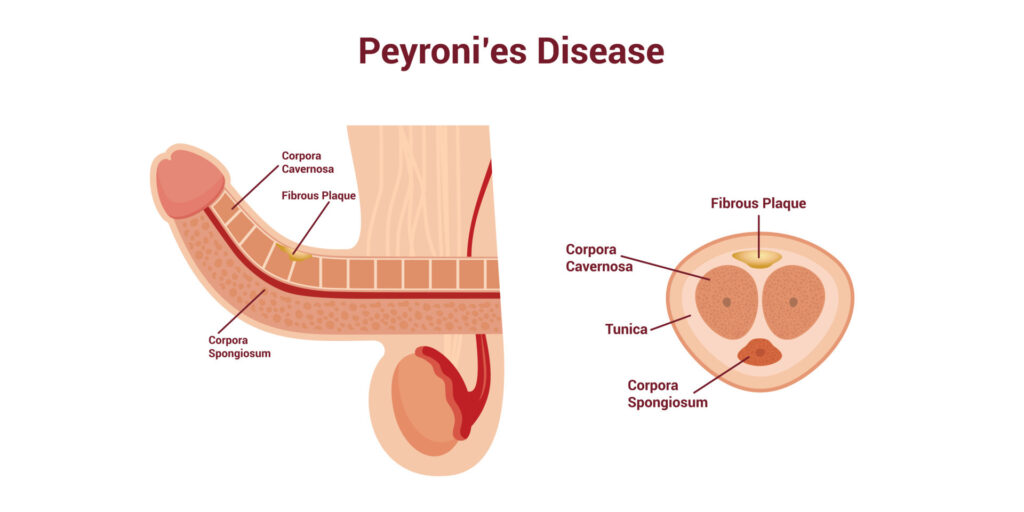 Malattia di Peyronie