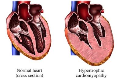 cuore ipertrofico