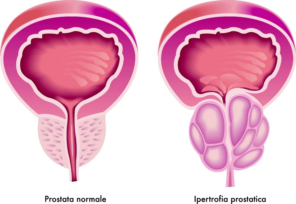 Iperplasia Prostatica
