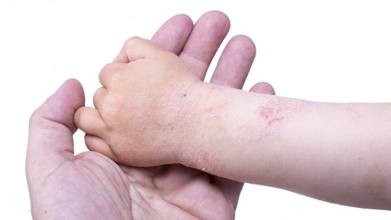 curare dermatite atopica neonato