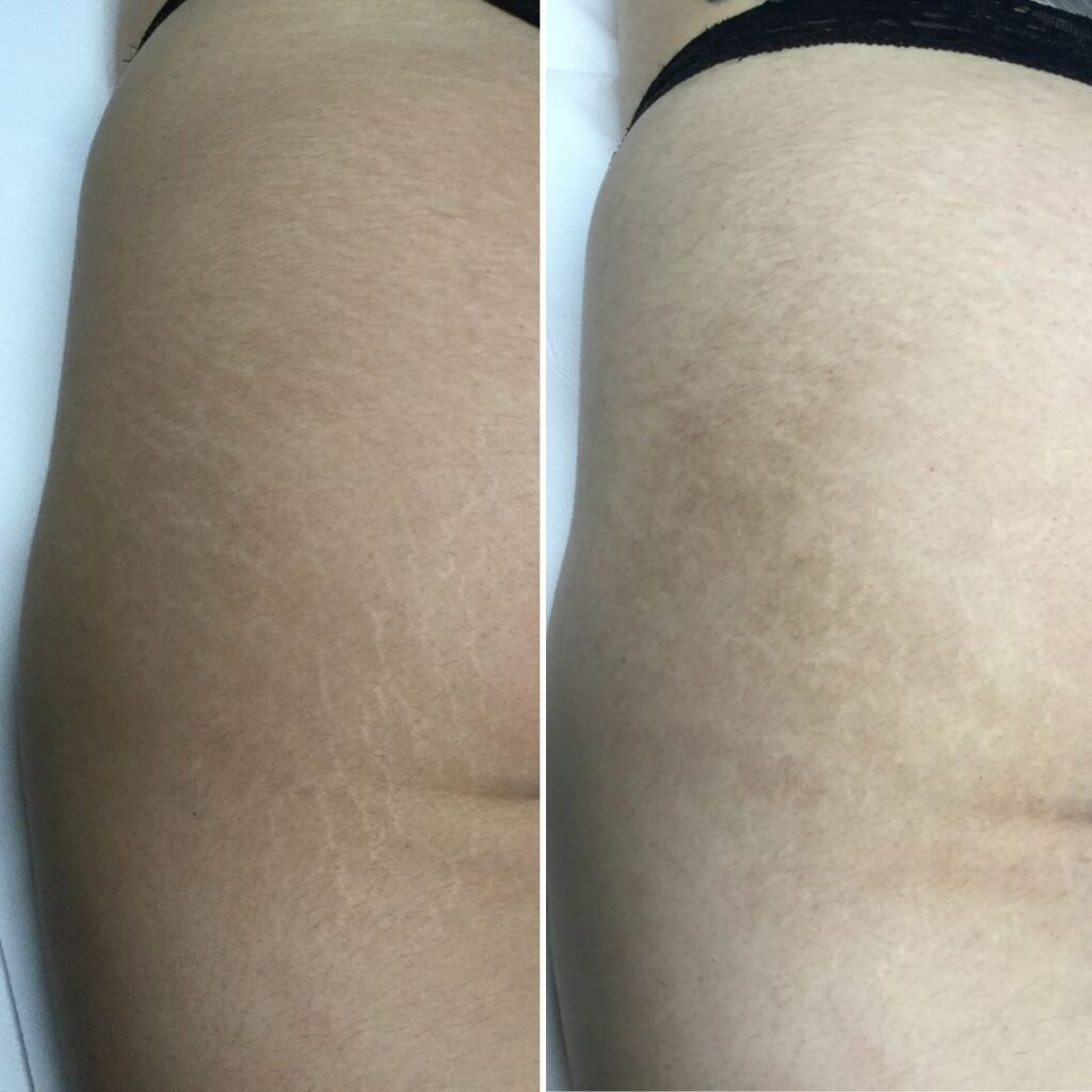 trattamento laser smagliature