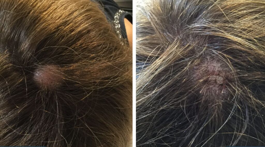efficacia laser rimozione cisti
