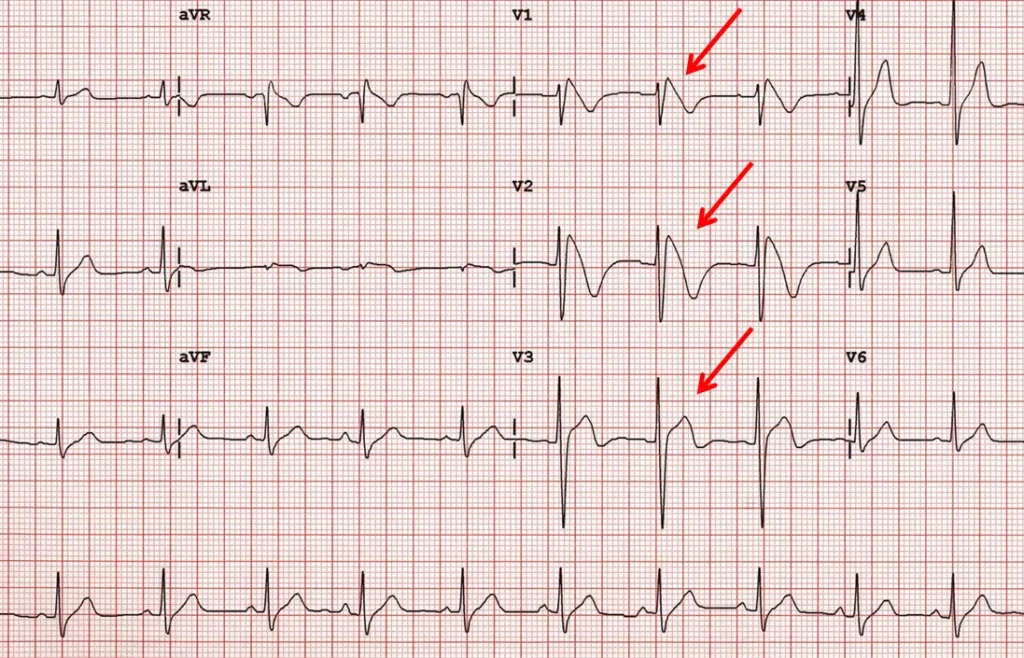 Sindrome Brugada