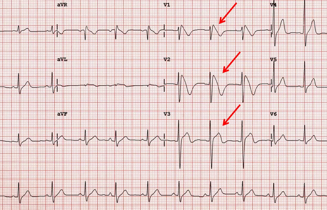 Sindrome Brugada