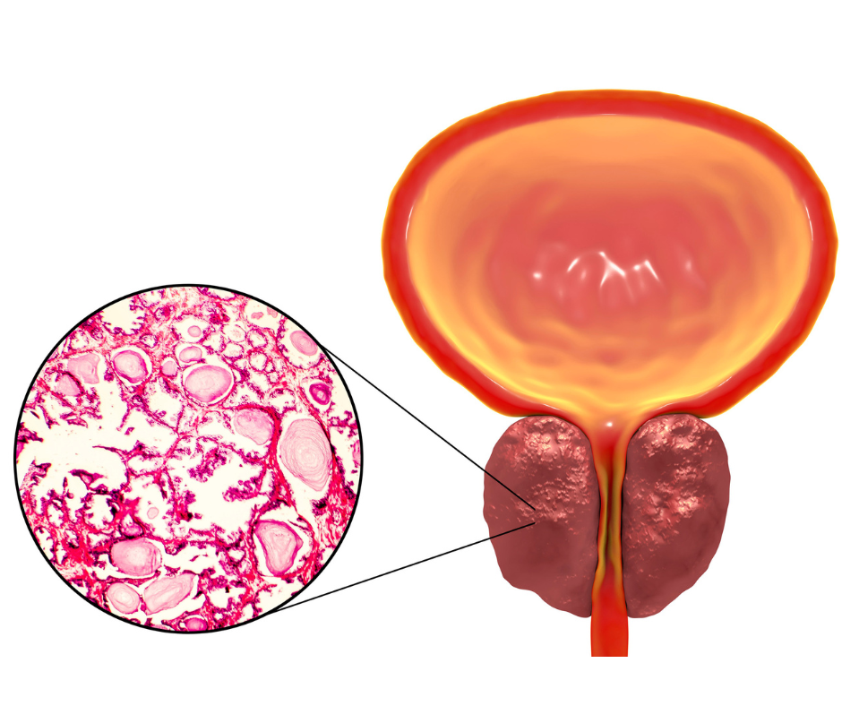 Ipertrofia-Prostatica-Benigna