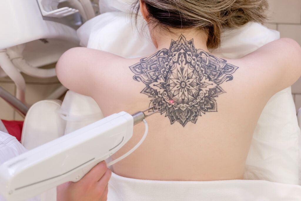 Rimozione del Tatuaggio con il Laser