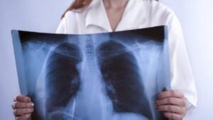 Che sintomi ha la fibrosi polmonare?