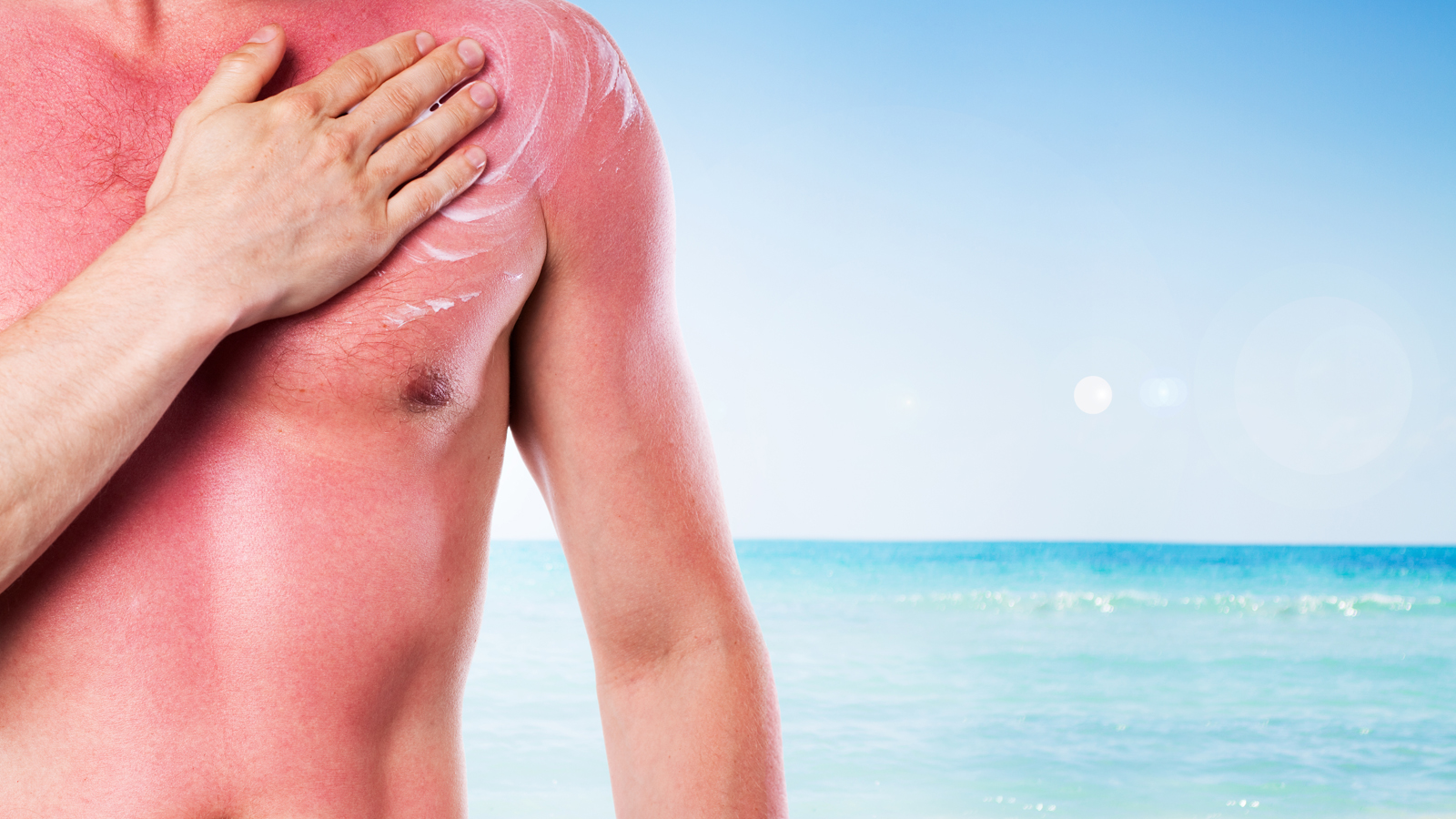 Quali sono i sintomi della Dermatite solare?