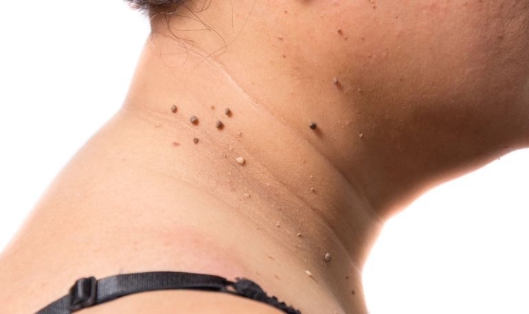 fibromi-penduli-laser-rimozione