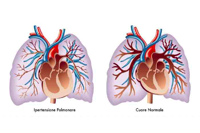 Cos'è l'ipertensione polmonare? E come si cura?