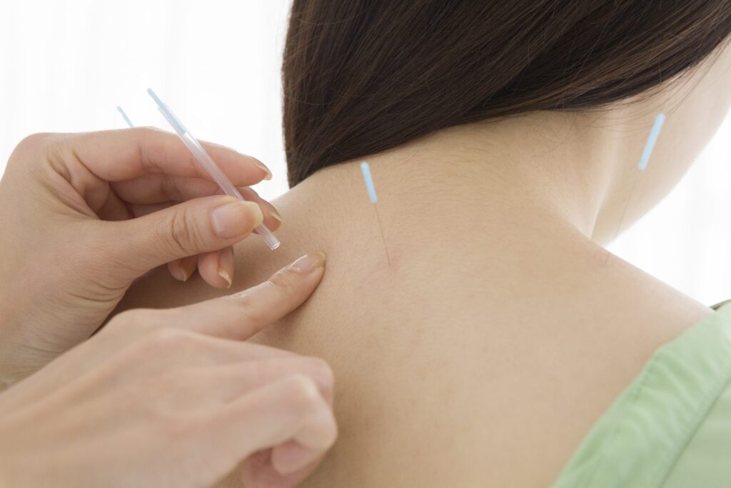 l'agopuntura funziona per la cervicale