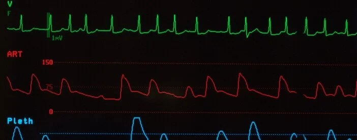 quanto si vive con l'aritmia atriale