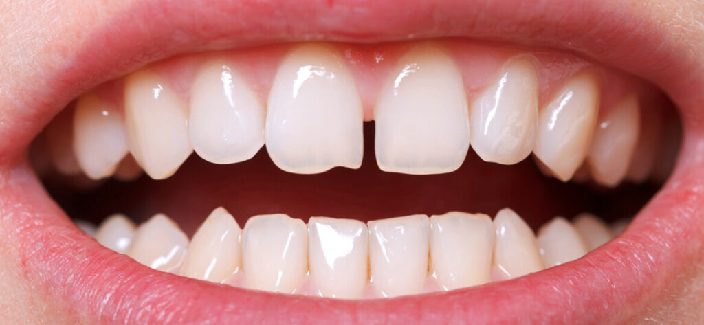ricostruzione spazio tra i denti