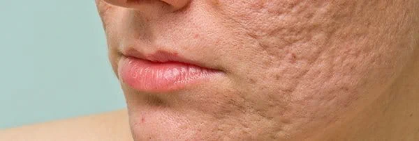 cicatrici acne
