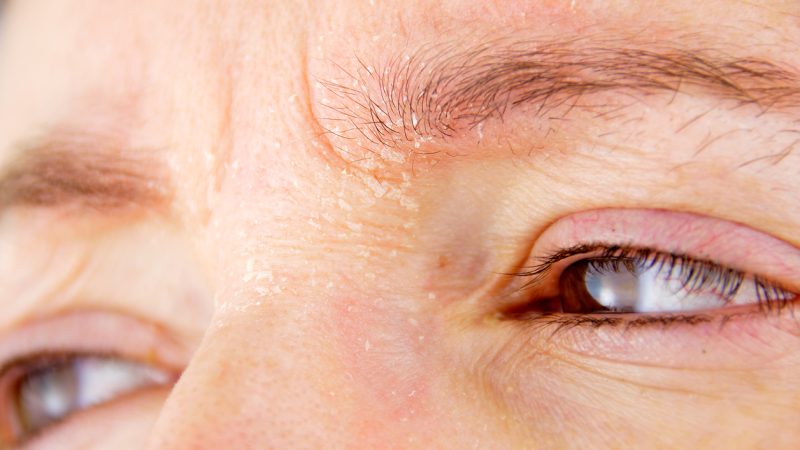 woman with atopic dermatitis dermatite palpebrale